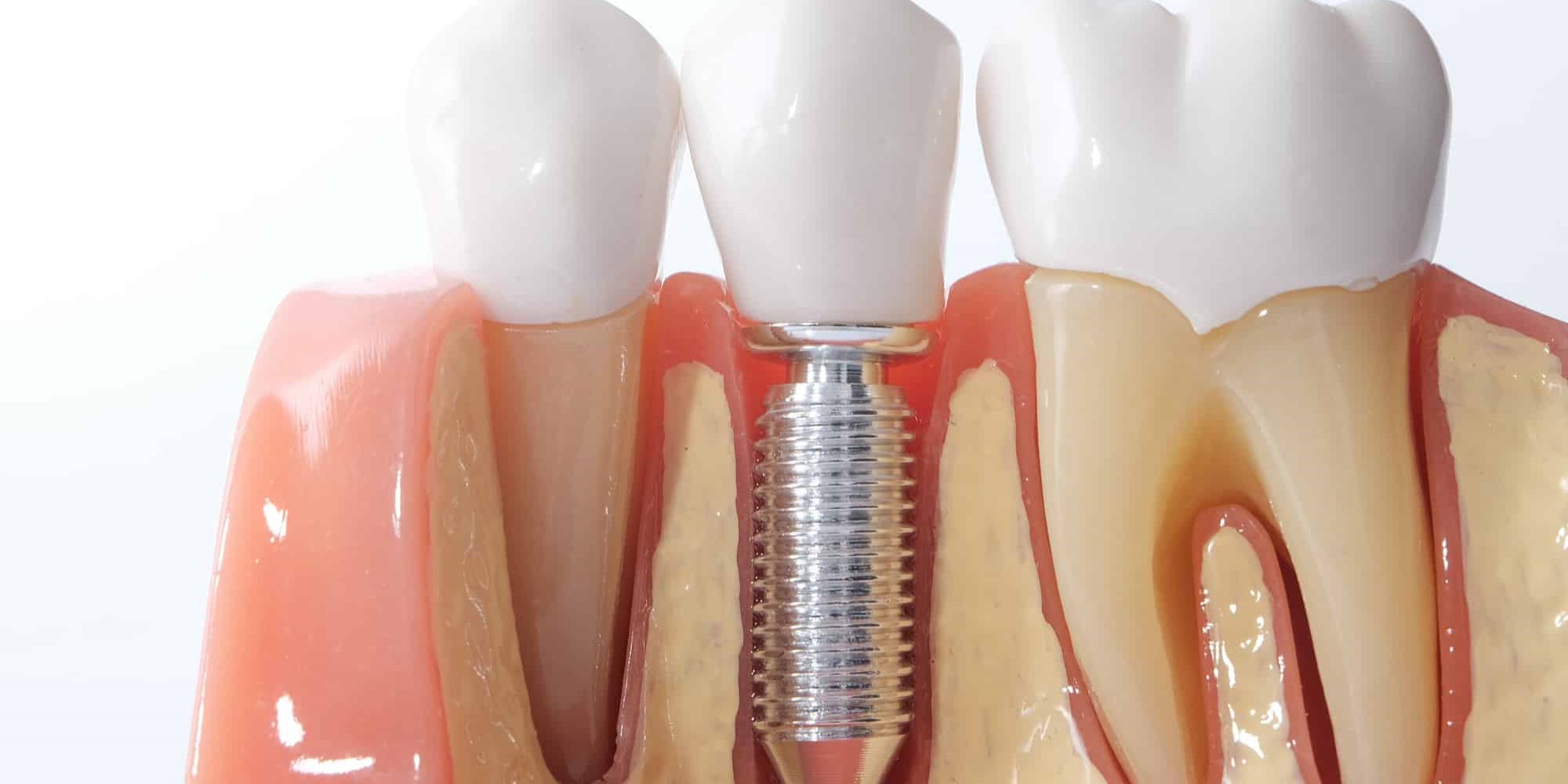 Implants dentaires